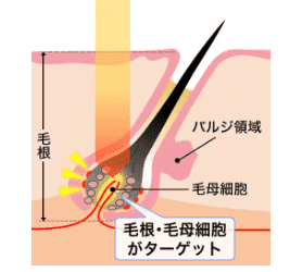 熱破壊式の画像